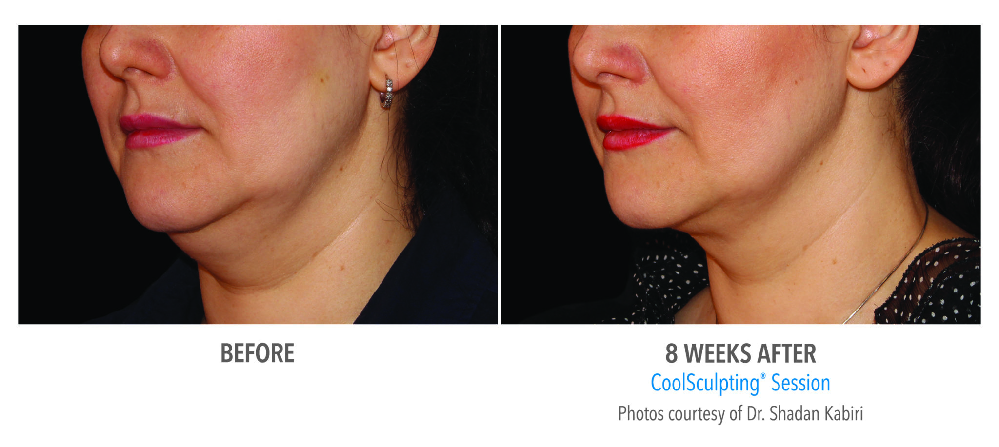 COOLSCULPTING