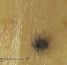 Today is Melanoma Monday